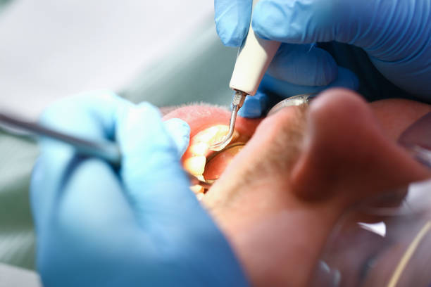 Best Knocked-Out Tooth (Avulsed Tooth) Treatment in Taylor Creek, OH